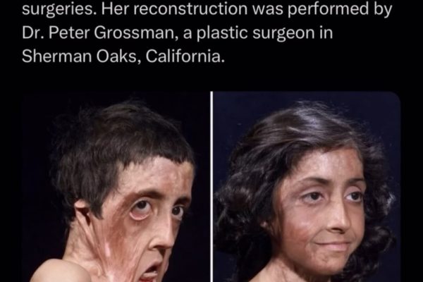 Burned but Not Broken: Zubaida Hasan’s Incredible Journey of Survival