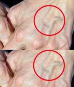 Have you ever looked down and noticed veins on your hands, arms, legs, or even chest that seem to have appeared out of nowhere?