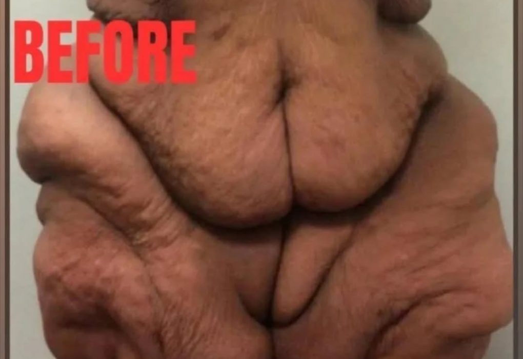 The world’s heaviest woman, who consumed a lot of milkshakes and weighed fifty stone, is no longer recognizable.