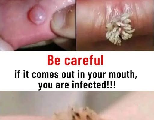 Be very careful if it comes out in your mouth, you are infected with…See more below