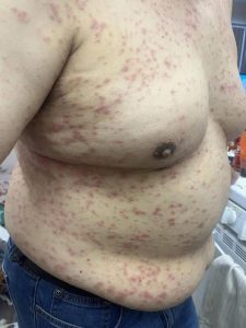 DOCTORS WARN: This Full-Body Itchy Rash In People Over 60 Should Never Be Ignored