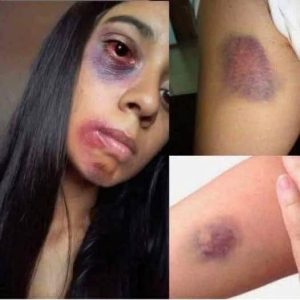 Dangerous Online Challenges: Teen Hospitalized After Experimenting with Foreign Objects