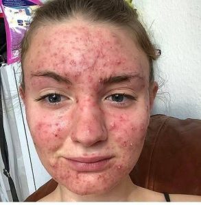 She Thought It Was Just an Allergy—The Truth Was Far More Serious