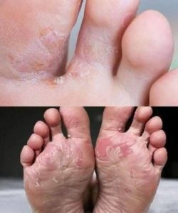 Warning Signs on Your Feet That Could Point to Hidden Diabetes